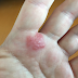 How to Treat Contact Dermatitis