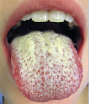 <Img src="Candidiasis_dorso_lingual.jpg" width = "350" height "405" border = "0" alt ="Imagen de candidiasis del dorso de la lengua">