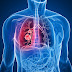 Get to know about Benign Mesothelioma 