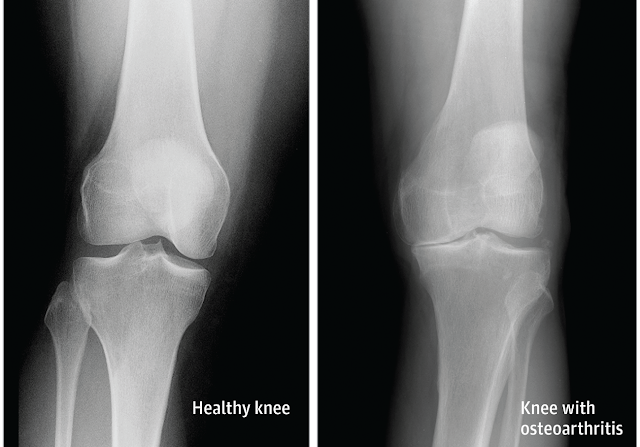 How Arthritis Can Affect the Knee | El Paso, TX Chiropractor