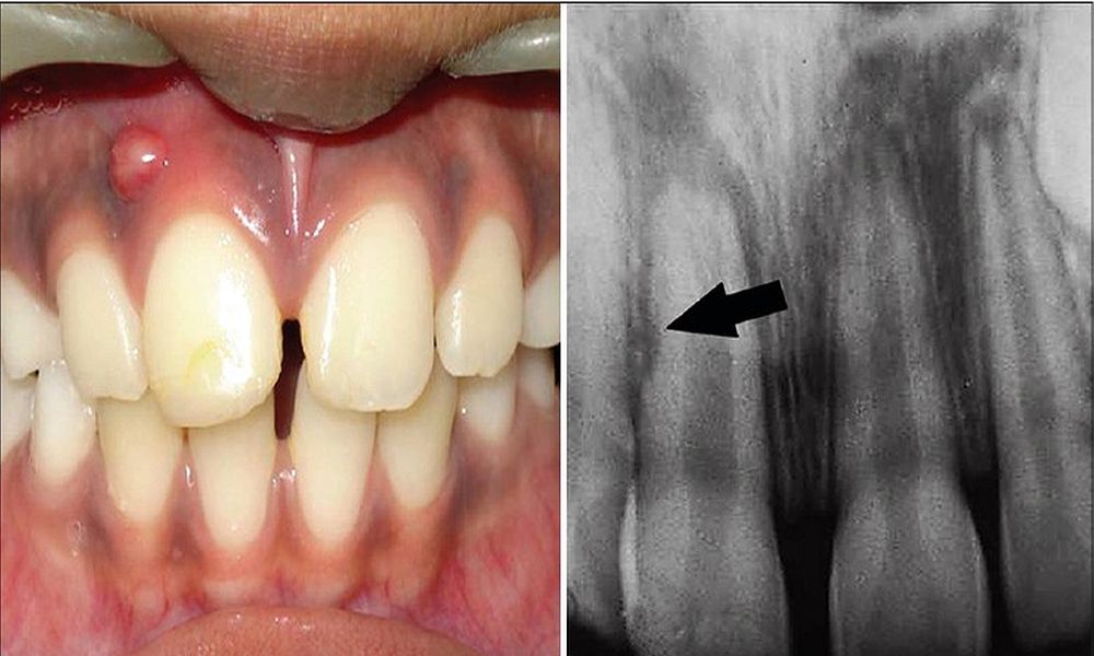 Odontogenic Infections