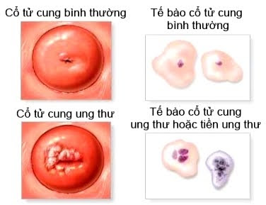 Tế bào ung thư cổ tử cung