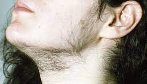 WHAT IS FACIAL HAIR/HIRSUTISM??MAIN CAUSES,REASONS,TESTS,TREATMENT                                                                                  WHAT IS FACIAL HAIR/HIRSUTISM??MAIN CAUSES,REASONS,TESTS,TREATMENT                                                                                          WHAT IS FACIAL HAIR/HIRSUTISM??MAIN CAUSES,REASONS,TESTS,TREATMENT                                                                                                               WHAT IS FACIAL HAIR/HIRSUTISM??MAIN CAUSES,REASONS,TESTS,TREATMENT                                                                                    WHAT IS FACIAL HAIR/HIRSUTISM??MAIN CAUSES,REASONS,TESTS,TREATMENT                                                                               WHAT IS FACIAL HAIR/HIRSUTISM??MAIN CAUSES,REASONS,TESTS,TREATMENT