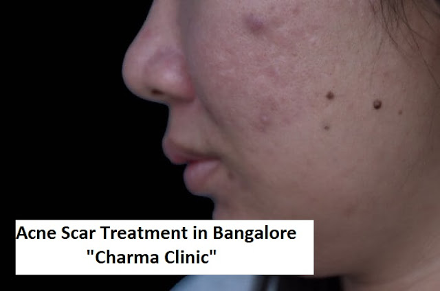 Acne Treatment With Laser And Chemical Peel
