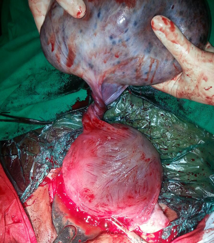 Journal of Postgraduate Gynecology & Obstetrics: Adnexal Torsion Leading To Ovarian  Cyst Rupture With Hemoperitoneum