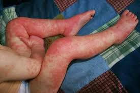 disease eczema.