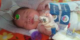 gambar bayi yang selamat berkat terapi es