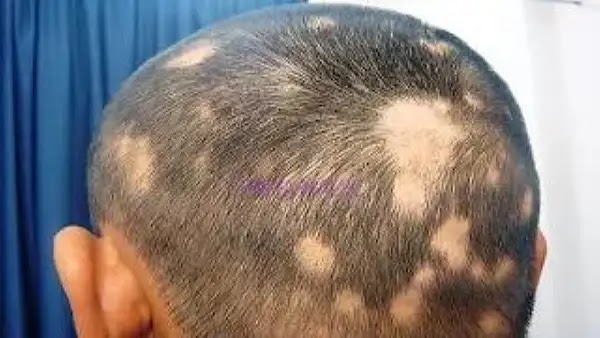 Folk remedies for hair loss