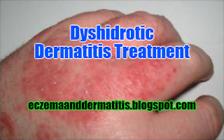 Dyshidrotic Dermatitis Treatment