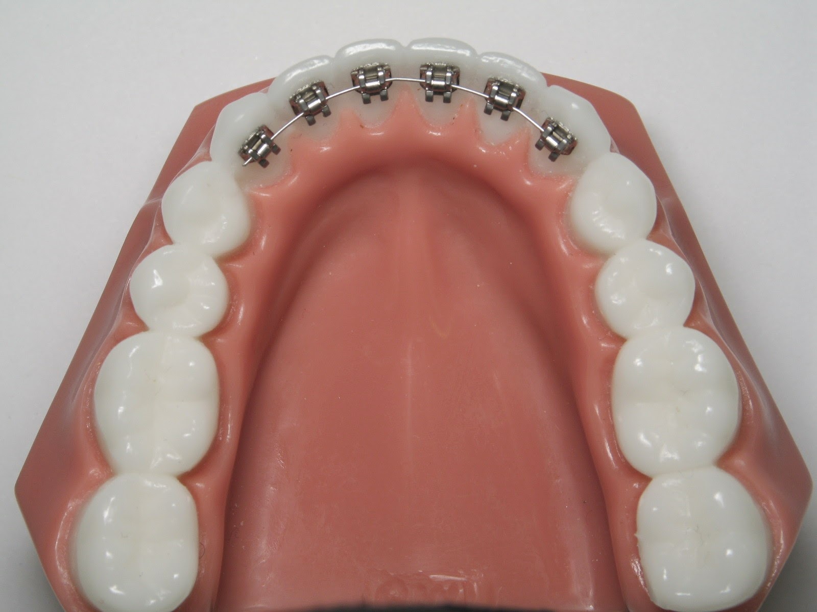 Lingual Braces