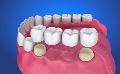 Các phương pháp làm răng giả có lâu không-2