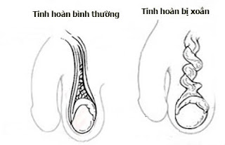 Nơi điều trị xoắn tinh hoàn Đà Nẵng