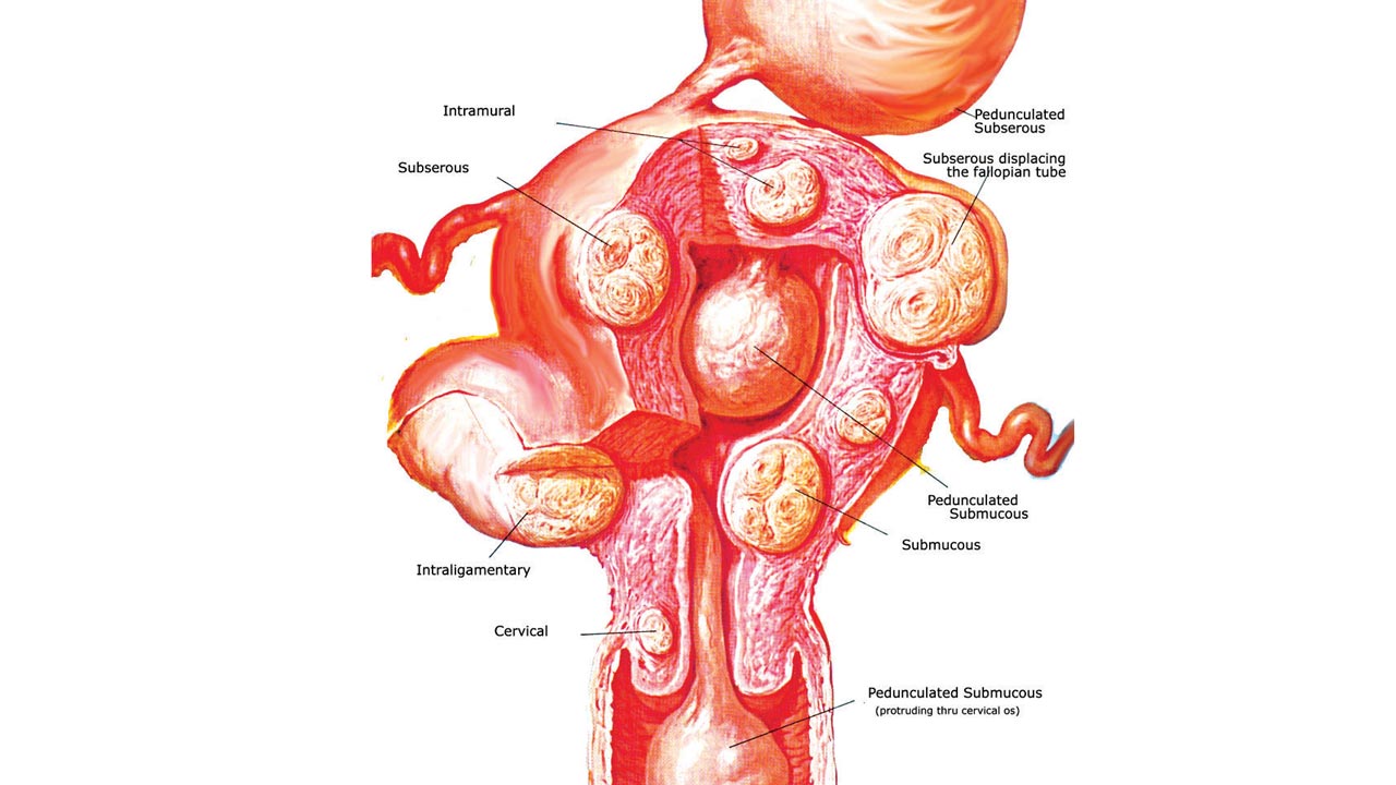 Fibroid tumors: What are the causes of fibroid