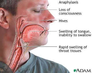 Anaphylactic Shock