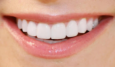 Quy trình bọc răng sứ cho răng khấp khểnh