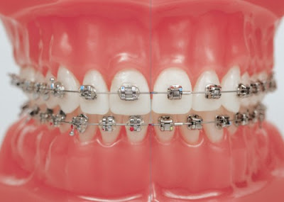 Niềng răng khểnh cho hàm răng đều đặn