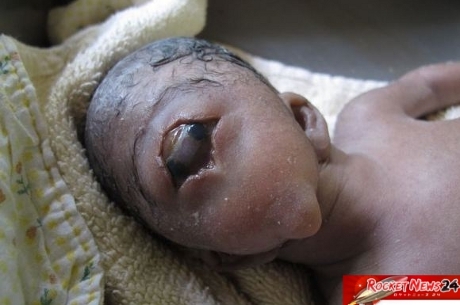 Fim dos tempos? Mulher dá à luz um bebê sem nariz e com um olho só