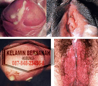 Cara Menyembuhkan Vagina Yang Perih Dan Bernanah