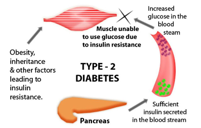Diabetes Overview - Symptoms, Causes, Treatment