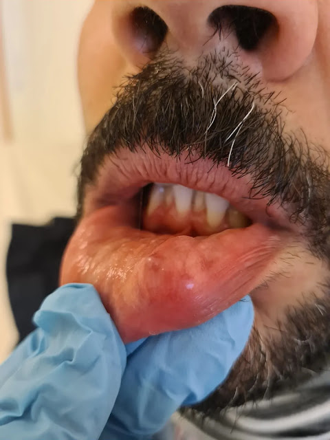 mucocele of tongue, mucocele extraction, mucocele surgery videos