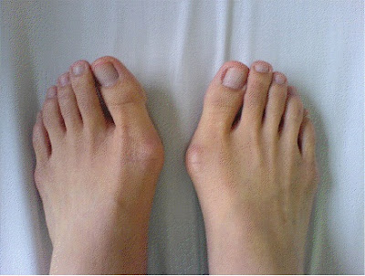 Hallux Valgus Surgery - What Is Hallux Valgus