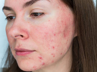 Rosacea Clinic in Manchester near Me