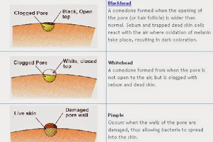 Knowing the Types for Acne 
