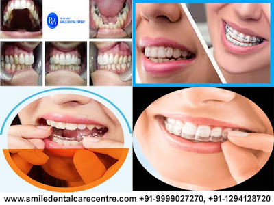 Best Invisible Aligner Treatment in Faridabad