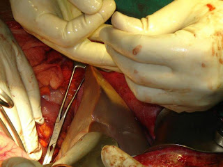 Liver Transplatation