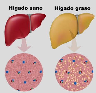 recetas para higado graso