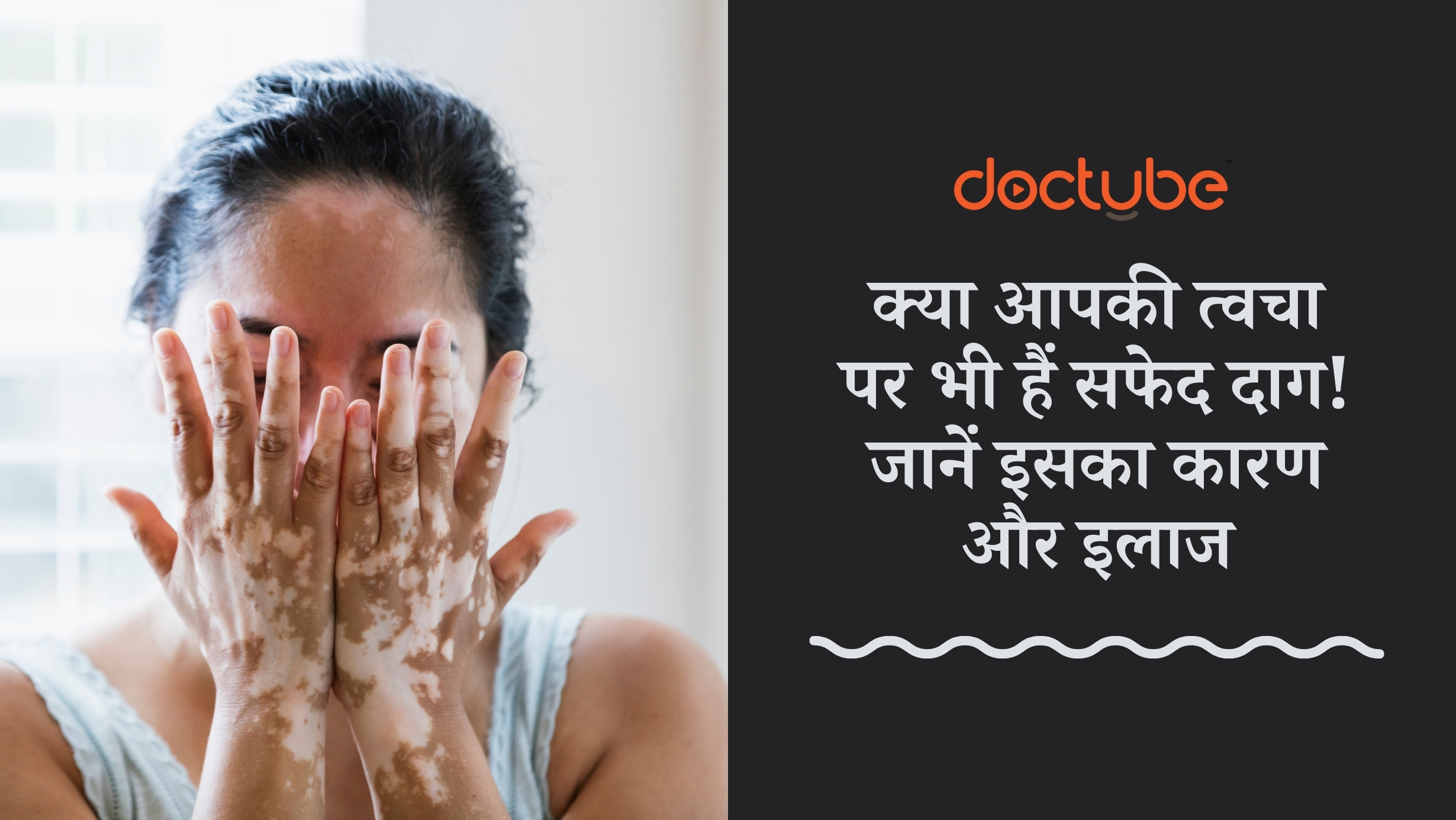 सफेद दाग:DocTubeBlog