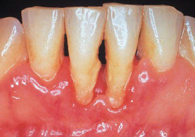 Cao răng huyết thanh là gì?