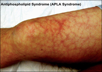 APLA Syndrome