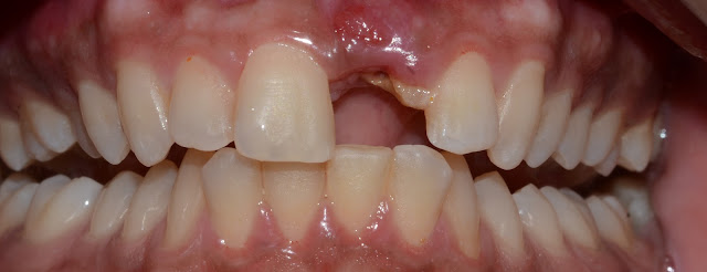 Before Treatment of Replacement of Tooth || Fracture Central Incisor