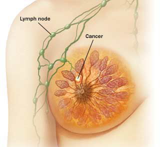 nikotin utice na rak dojke