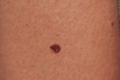 Melanoma Symptoms And Stages