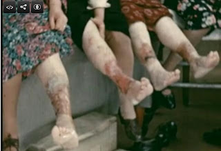 3 women showing their varicose veins after being pregnant