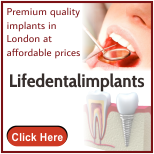 Dental Implants London