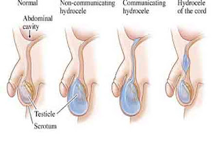 Địa chỉ chữa trị giãn tĩnh mạch thừng tinh an toàn Đà Nẵng