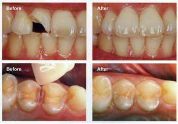 Phương pháp khắc phục răng cửa bị thưa