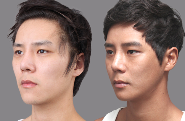 짱이뻐! - Before and After Photos Korean Plastic Surgery for Men