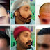Hair Transplant | Ludhiana Hair Transplant