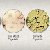The Various Types of Crystals Found In  Urine with Their Clinical Significance
