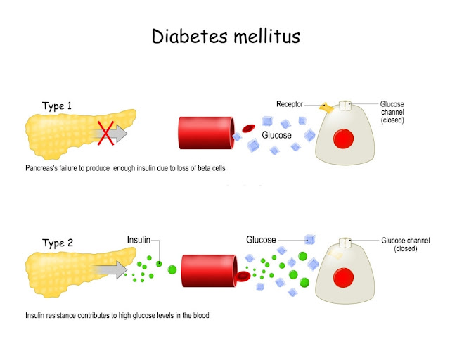 Diabetes Types
