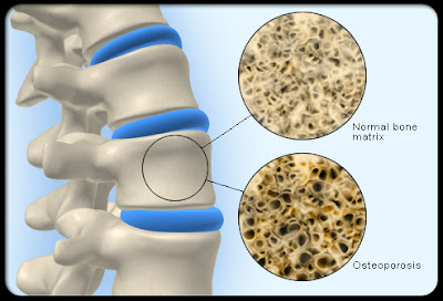 Osteoporosis