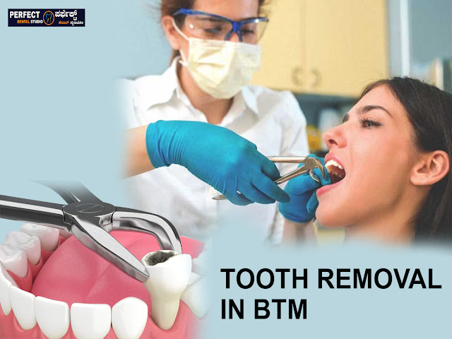 Tooth Removal in BTM Layout