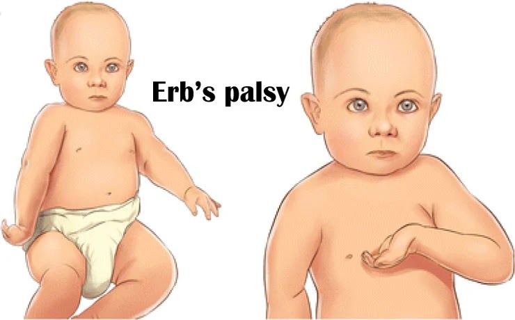 Erb's Palsy and the Brachial Plexus: Causes, Signs, Symptoms, and Treatment