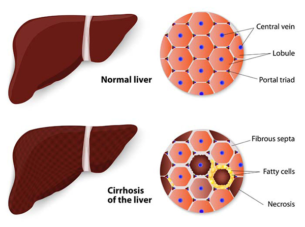One Can Prevent Liver Cirrhosis By Making Few Changes In Life Styles
