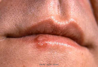 Cold Sore Vs Oral Herpes : Want To Create Perfume Last Longer_