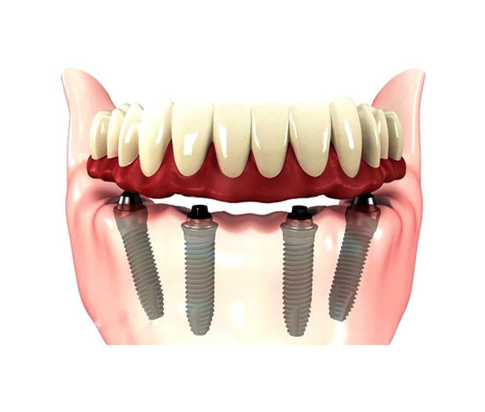 Dental Implants